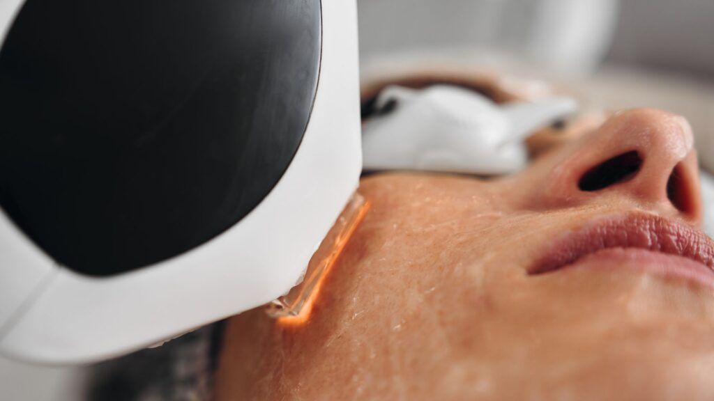 laser-m22-solucion-para-manchas-y-cicatrices