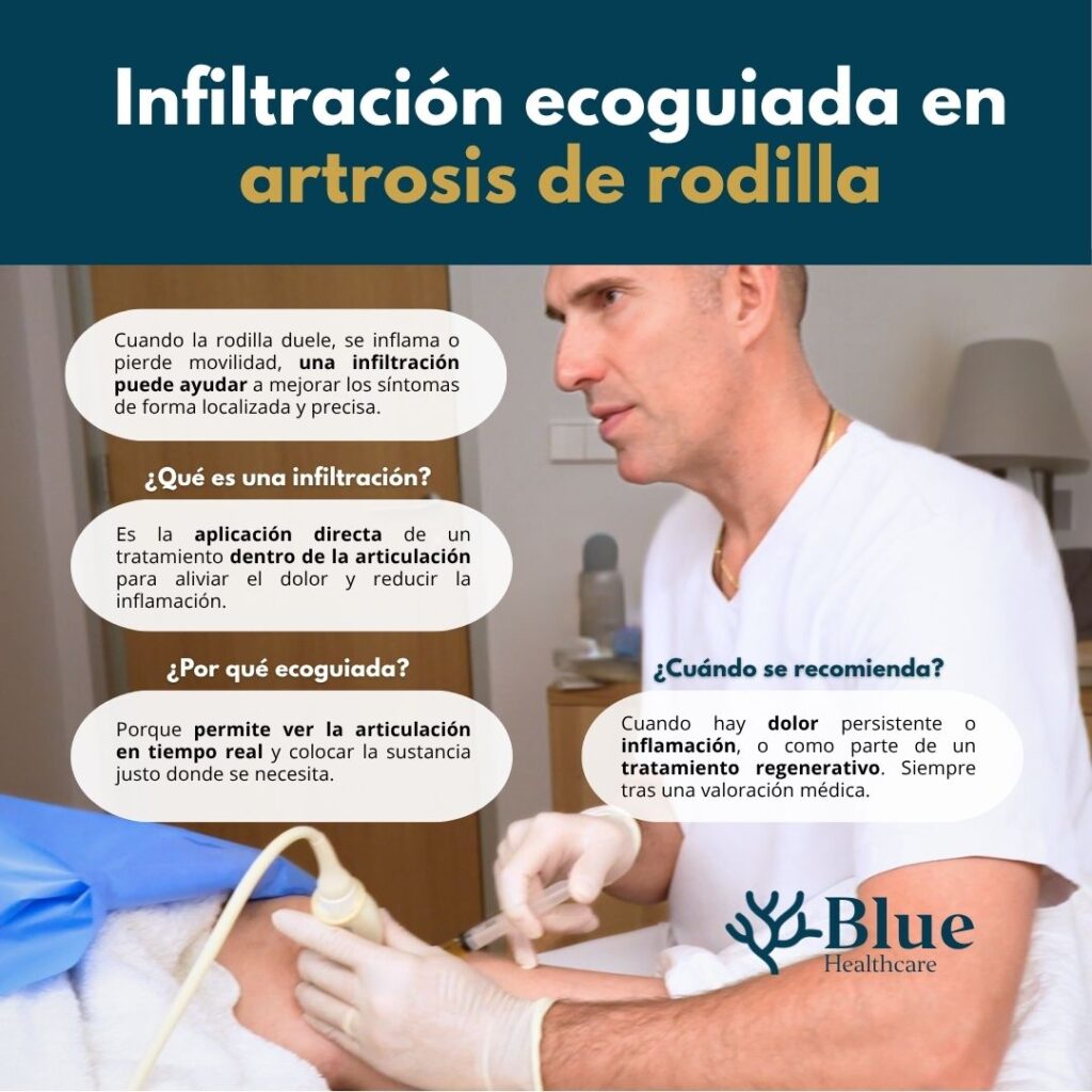 Infografía que muestra los tipos de infiltración para artrosis de rodilla