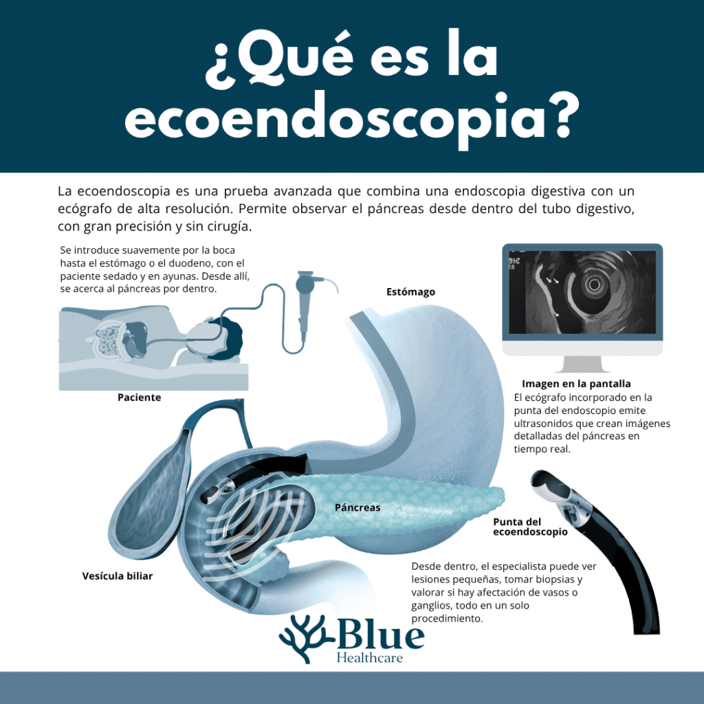 Pasos principales de la ecoendoscopia para detectar cáncer de páncreas