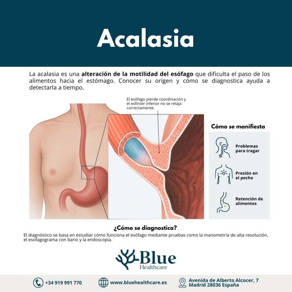 Infografía médica que explica qué es la acalasia, sus causas y su diagnóstico.