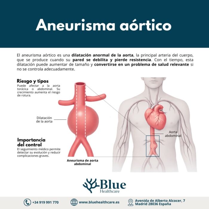 Aneurisma de aorta: qué es, dónde aparece y cómo se trata