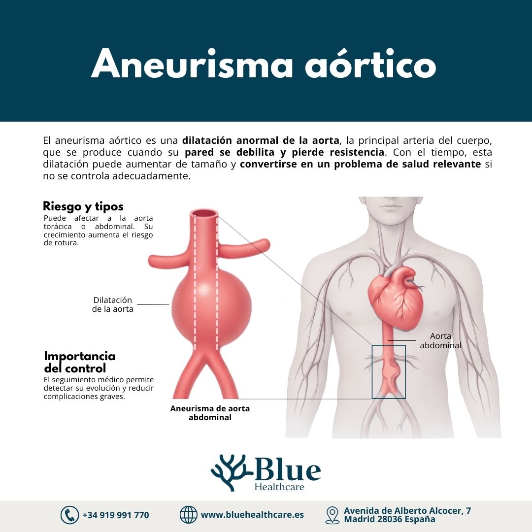 Aneurisma de aorta: qué es, dónde aparece y cómo se trata